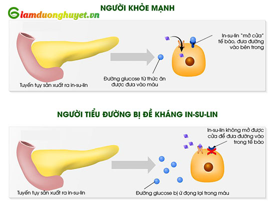 Đề kháng in-su-Iin là nguyên nhân gây ra tăng đường huyết, bệnh tiểu đường